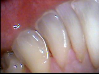 tooth1after